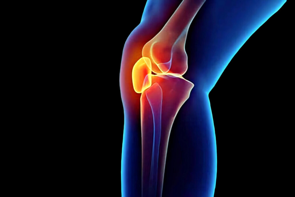 Knee Arthritis